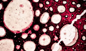 celule cancer shutterstock 78052687 0 jpeg