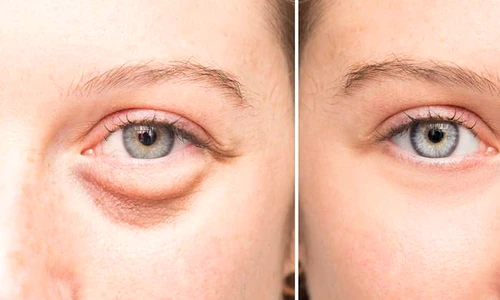 Cum tratezi pungile de sub ochi  Remediu natural care te scapă de inestetica problemă jpeg