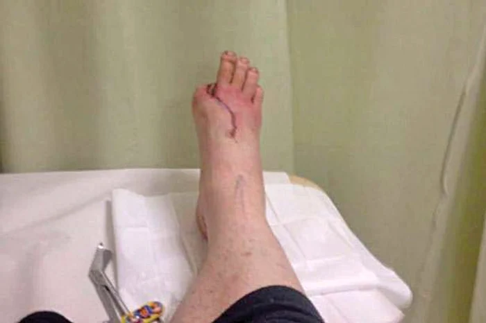 Nu regretă că şi-a ciopârţit piciorul