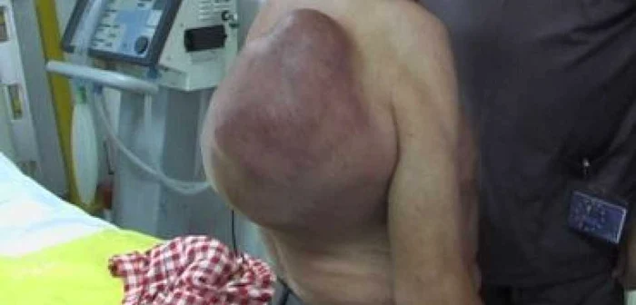 Iaşi: Tumoră la spate cât o minge