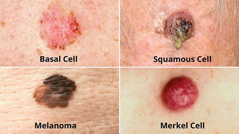 Legătura dintre cancer și produsele cosmetice. Mai 2024, luna cancerului de piele