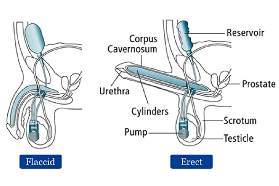 Chirurgilor le-au luat trei ani pentru a crea acest penis bionic