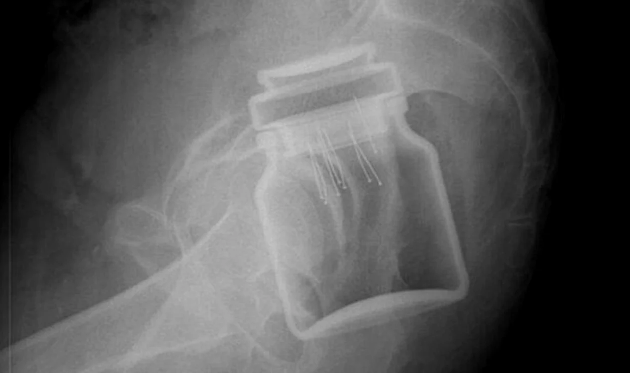 Aceasta este radiografia făcută bărbatului care avea borcanul în anusFoto:monitorulbt.ro