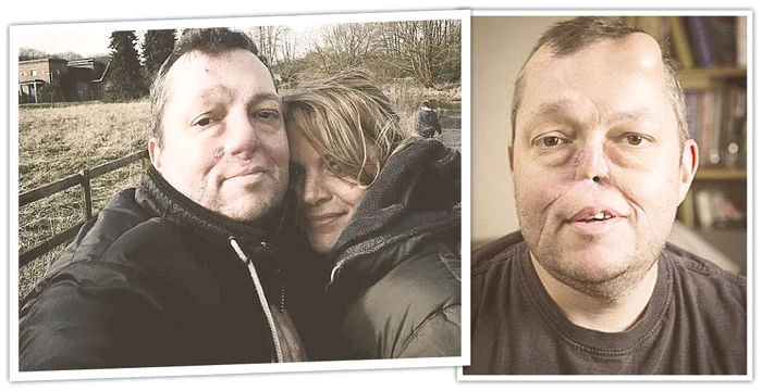 
    În 90 de zile, Paul Singleton, de 45 de ani, va avea nasul reparat  