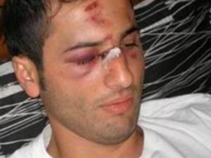 Aşa arăta ospătarul Berat Racaj după bătaia cu Mutu