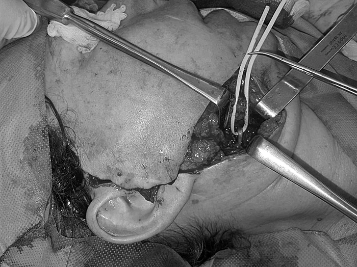 Operaţia de plantare a muşchiului luat de pe coapsă a durat peste 8 ore