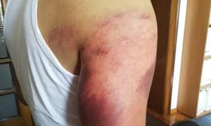 Mâna bărbatului este vânătă de la lovituri jpeg