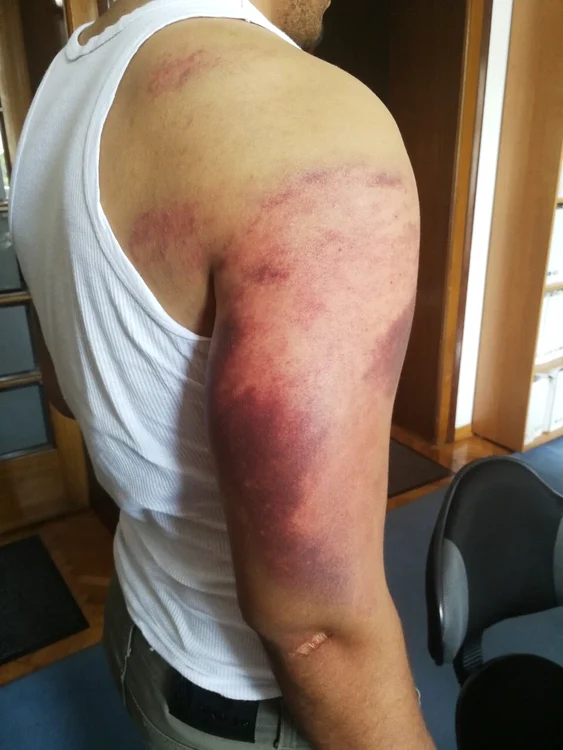 Mâna bărbatului este vânătă de la lovituri