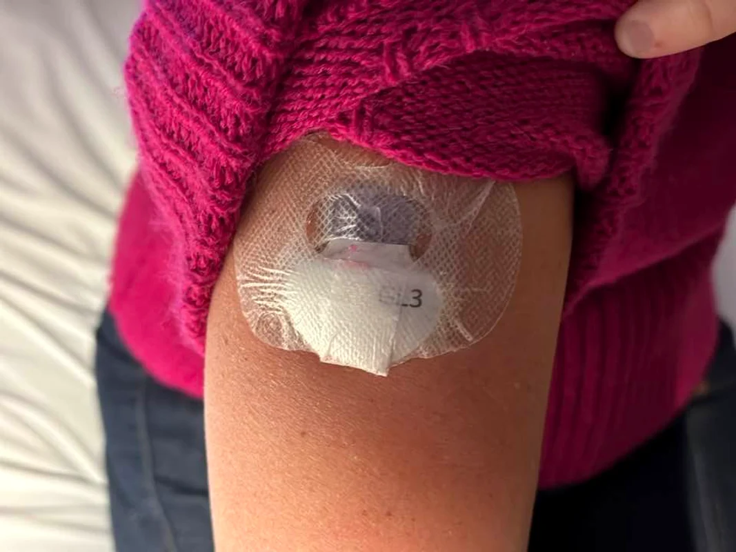 Pompă de insulină montată unui tânăr de către dr. Anca Nicoară. FOTO Facebook