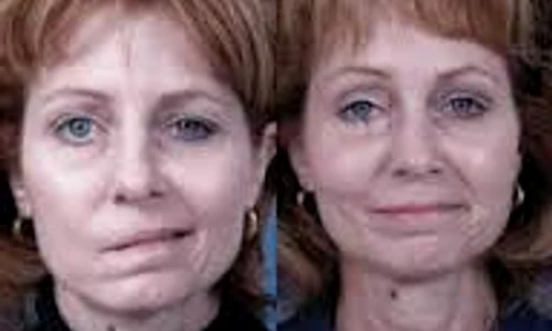 asimetria faciala copiisimamico ro  jpeg