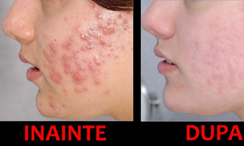 Tratament pentru coşuri  10 remedii naturiste pentru tenul tău problematic! png