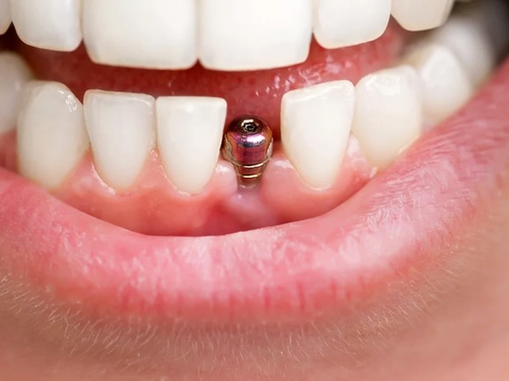 
    Implantul dentar are forma unui șurub, asemănător cu rădacina dentară  
