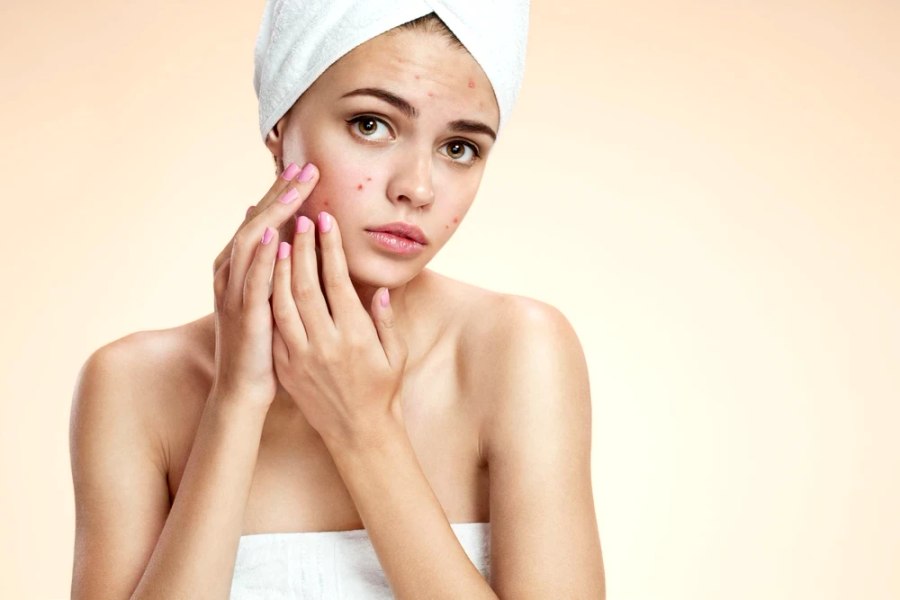 Avertisment privind bolile de piele la adoloscenți. Rutinele de skincare promovate pe TikTok sunt periculoase