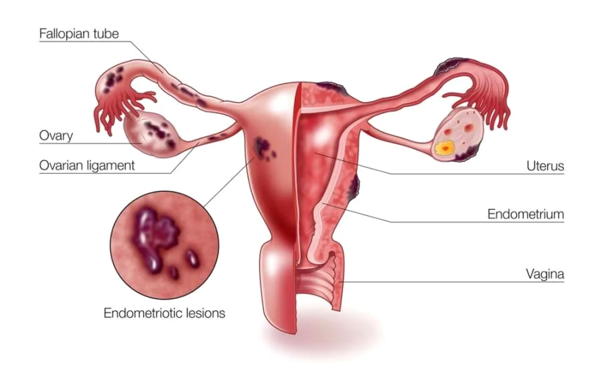 Este foarte important de știut că endometrioza este una dintre cele mai importante cauze de infertilitate. 