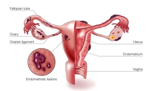 Este foarte important de știut că endometrioza este una dintre cele mai importante cauze de infertilitate   jpeg