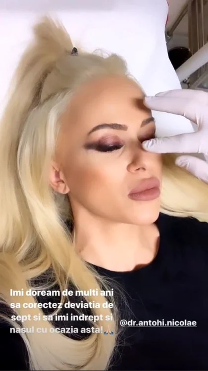 Anda Adam și-a rezolvat deviația de sept și în aceeași intervenție estetică și-a remodelat și nasul