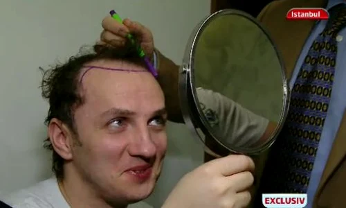 Doctorul i a trasat forma optima podoabei lui capilare, pentru a realiza intervenţia (fotocaptură: PRO TV) jpeg