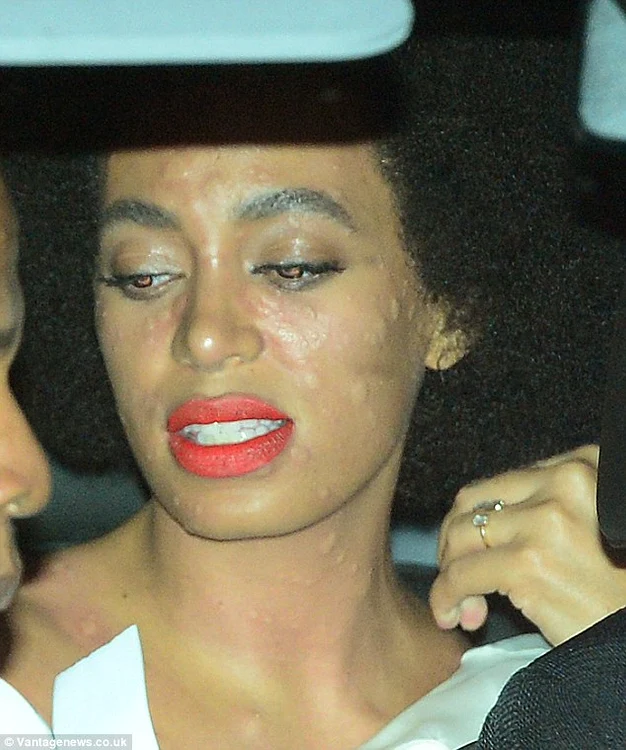 Solange, plină de bube pe faţă, după nuntă