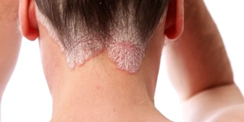 Stresul ne poate afecta pielea destul de serios Foto