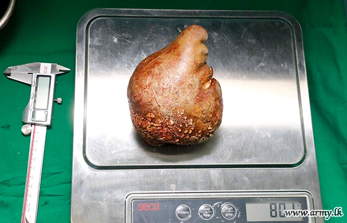 Calculul renal cântarea 801 grame Foto: army.lk