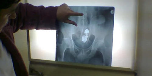 Spray-ul era complet băgat în anus cu tot cu capac