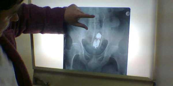 Spray-ul era complet băgat în anus cu tot cu capac