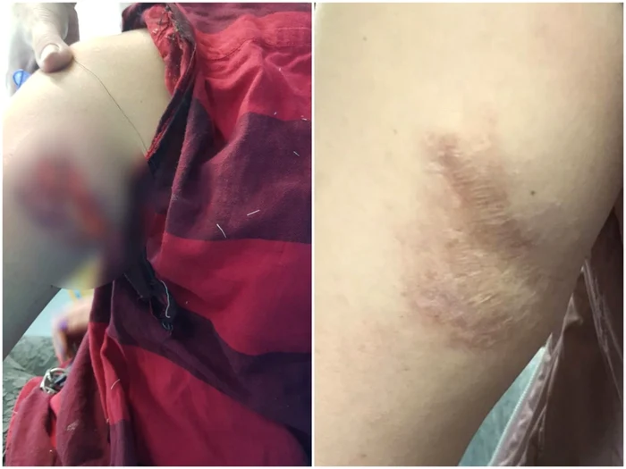 Urmările atacului câinelui sunt vizbile și acum FOTO Adevărul