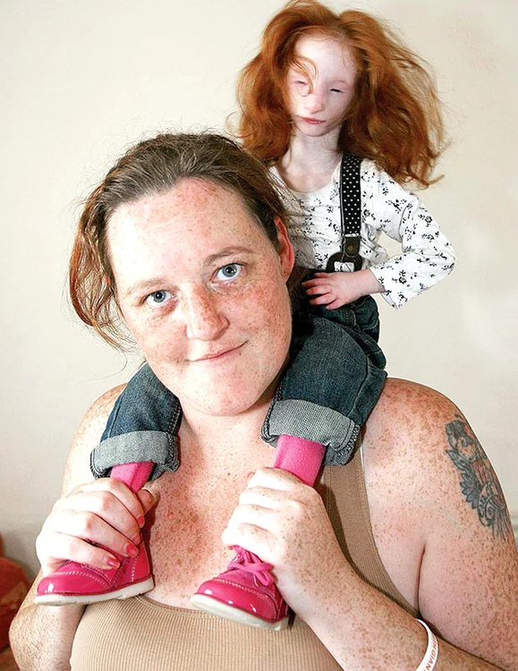 
    Normal, la vârsta  ei, micuţa ar fi trebuit  să aibă o înălţime  de 1,40 m și o  greutate de 35 kg  