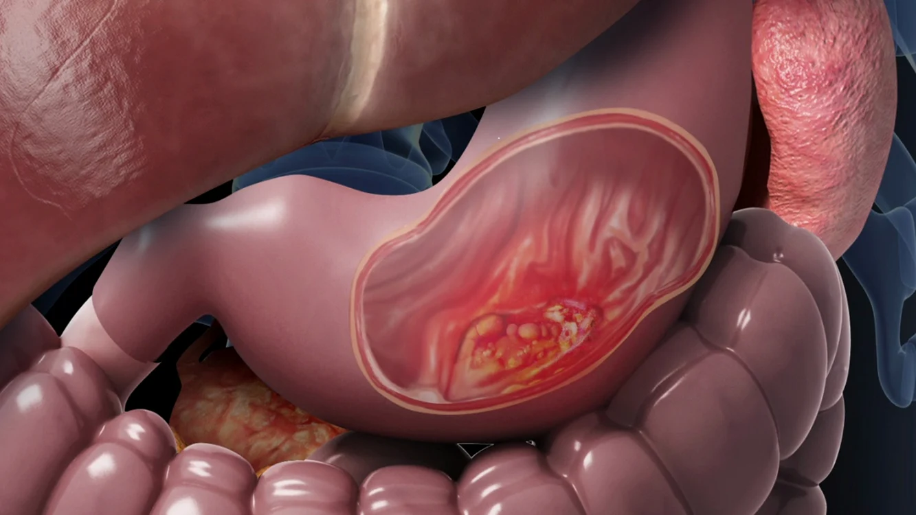 Ilustrație pentru cancerul gastric