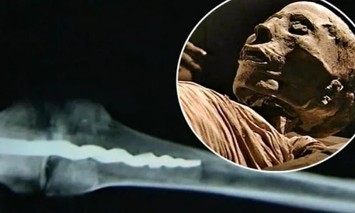 Descoperire uimitoare: operații ortopedice efectuate în Egiptul Antic jpeg