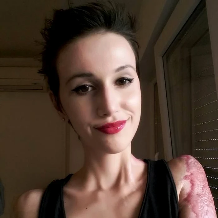 
    A avut arsuri grave pe mâna stângăFoto: Facebook  