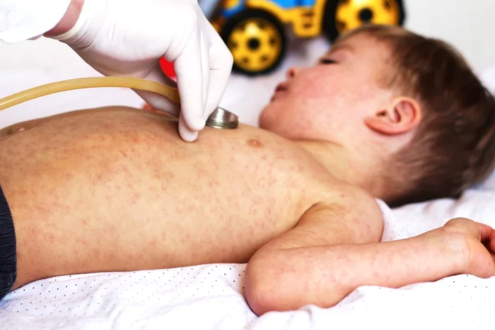 Rujeola, o boală contagioasă care poate da complicații la copiii nevaccinați FOTO Shutterstock
