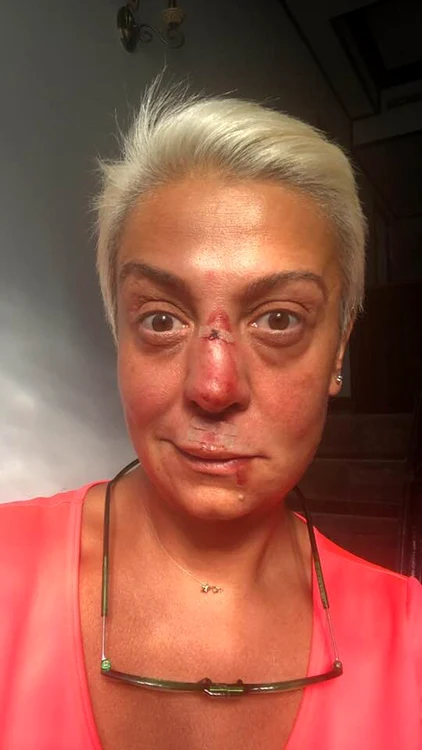 Monica Anghel s-a accidentat la călărie