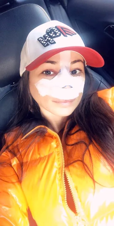 Roxana Vancea, după operația de rinoplastie 