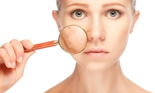 hiperpigmentare jpeg