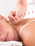 acupunctura jpg