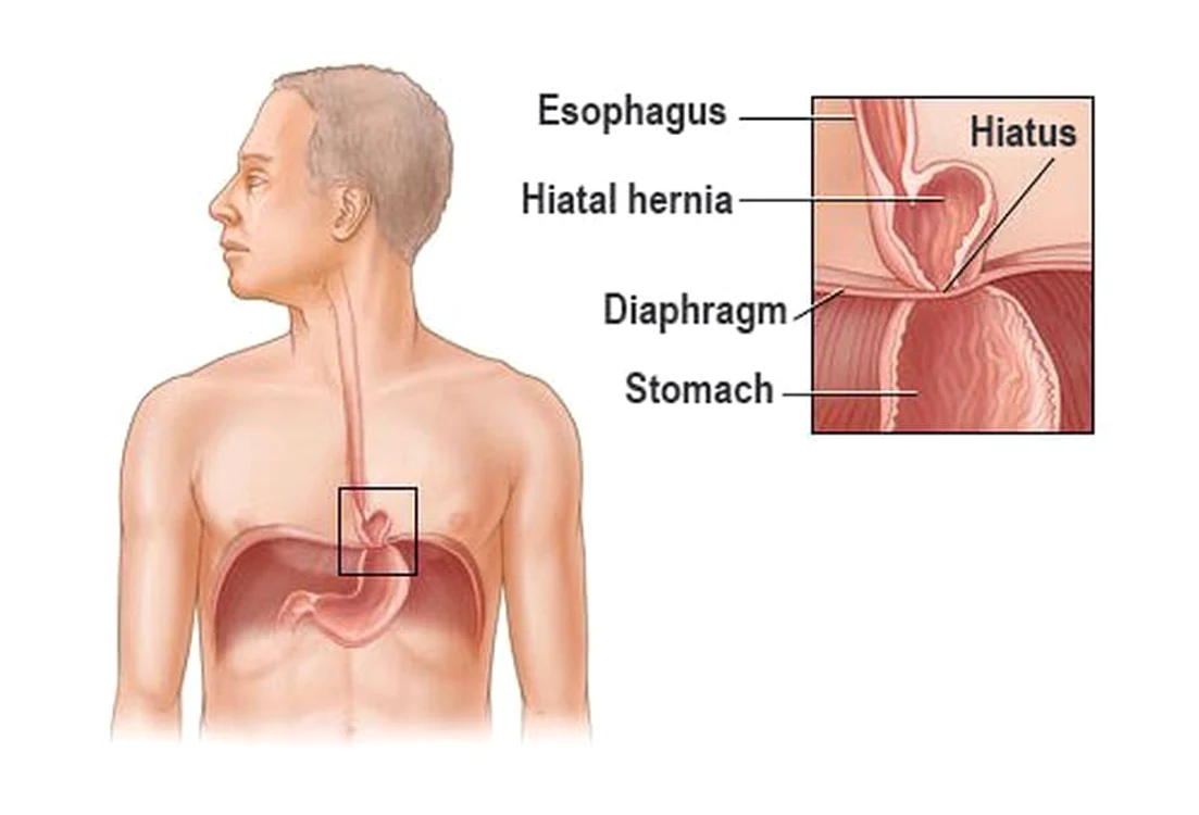 hernia de stomac jpeg