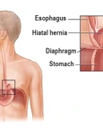 hernia de stomac jpeg