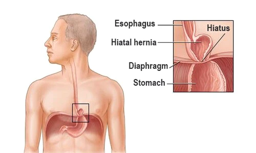 hernia de stomac jpeg