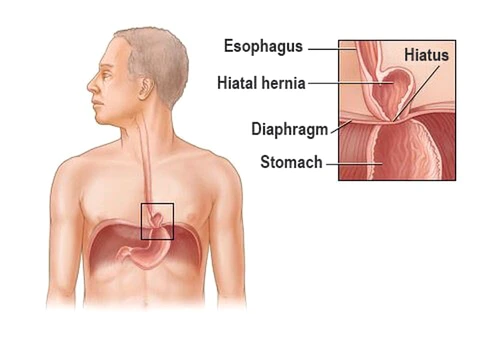 hernia de stomac jpeg