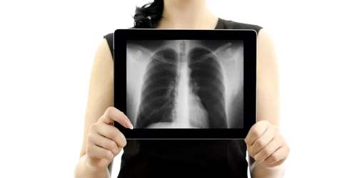 plamani radiografie Shutterstock