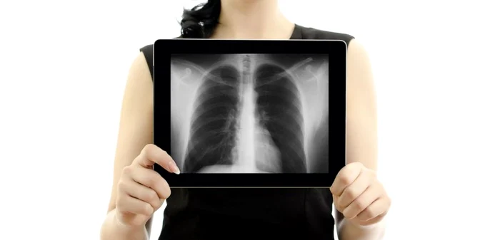 Nodulul pulmonar se evidenţiază de cele mai multe ori întâmplător FOTO: Shutterstock