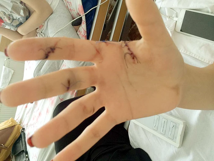 Medicii legişti au stabilit că adolescenta nu-şi va mai putea folosi niciodată mâna dreaptă la capacitate maximă