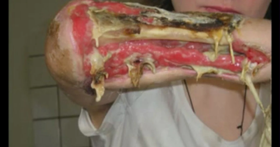 Infectarea "crocodilului" cauzează necrozarea ţesutului