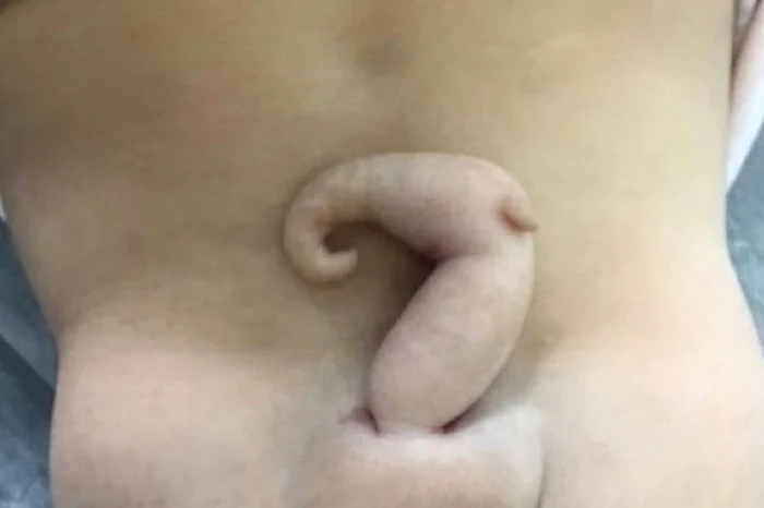 Fetița prezenta o coadă de 6 centimetri FOTO Journal of Pediatric Surgery Case Reports