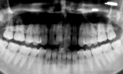 am vorbit cu cativa dentisti sa nteleg de ce romanii ajung la ei numai cand le cad dintii 754 body image 1453451100 size 1000 jpeg