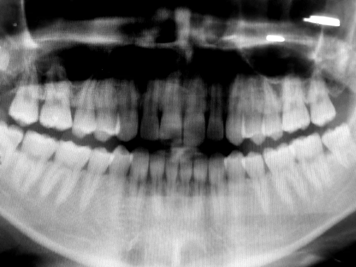 Radiografia unui pacientDick Thomas Johnson via Flickr