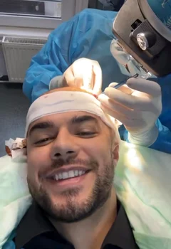 Culiță Sterp, la al treilea implant de păr Instagram
