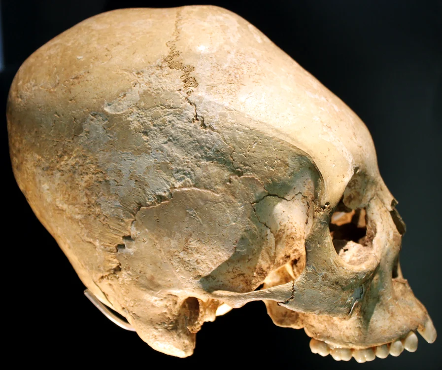Craniu alungit artificial aparținând triburilor alemanilor FOTO wikipedia