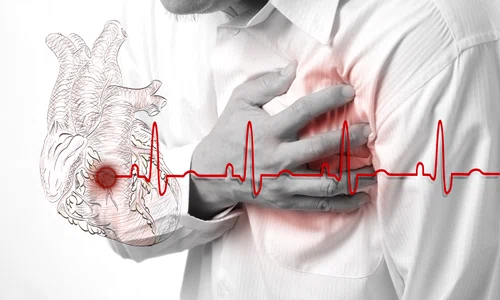infarct stop cardiac inima jpeg